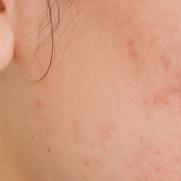 simptome de acnee