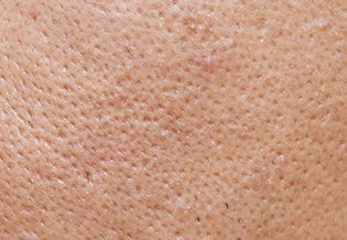 Laroche-Posay Romania articles acne 