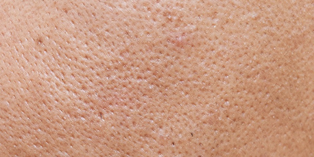 Laroche-Posay Romania articles acne