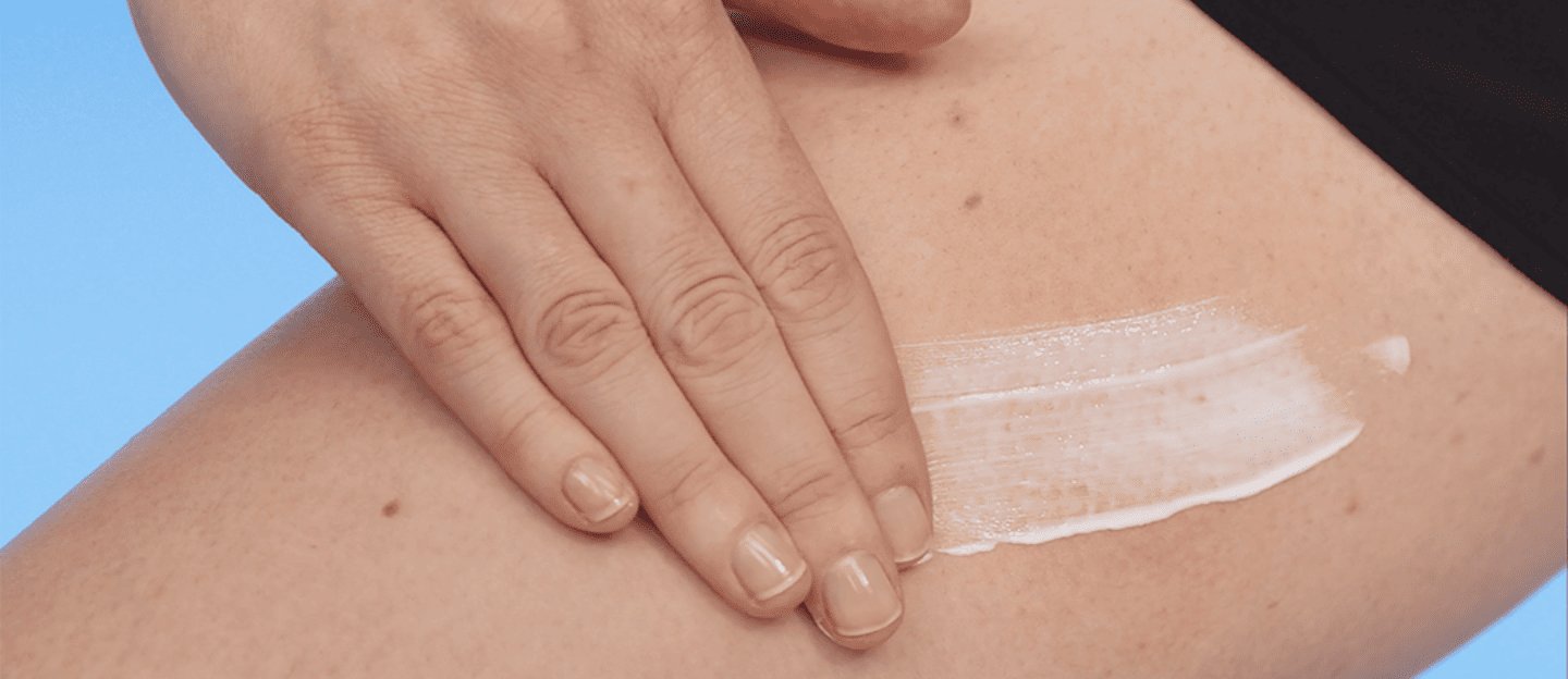 Eczema