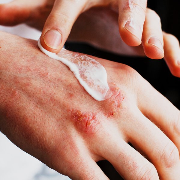 Tipuri de eczeme produse recomandate