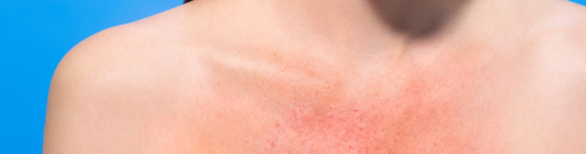 Protectia solara iti protejeaza pielea de radiatiile UV