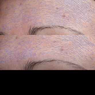 lrp_skfc_hyalub5_imhyalub5serum-2021-sitecore-before_after_card2